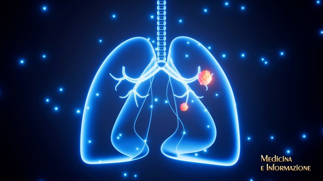 NODULI POLMONARI: la broncoscopia robotica rivoluzione la diagnosi per identificare lesioni tumorali