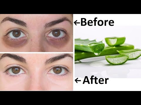 Comment utiliser de l’aloe vera pour les cernes