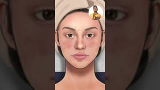 Acne and pimples best homeopathic treatment। Pimples and acne ka best ilaj। Blackhead best medicine।
