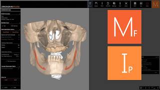 Bone Doctor Module And Implant-Planner Software Zirkonzahn.software