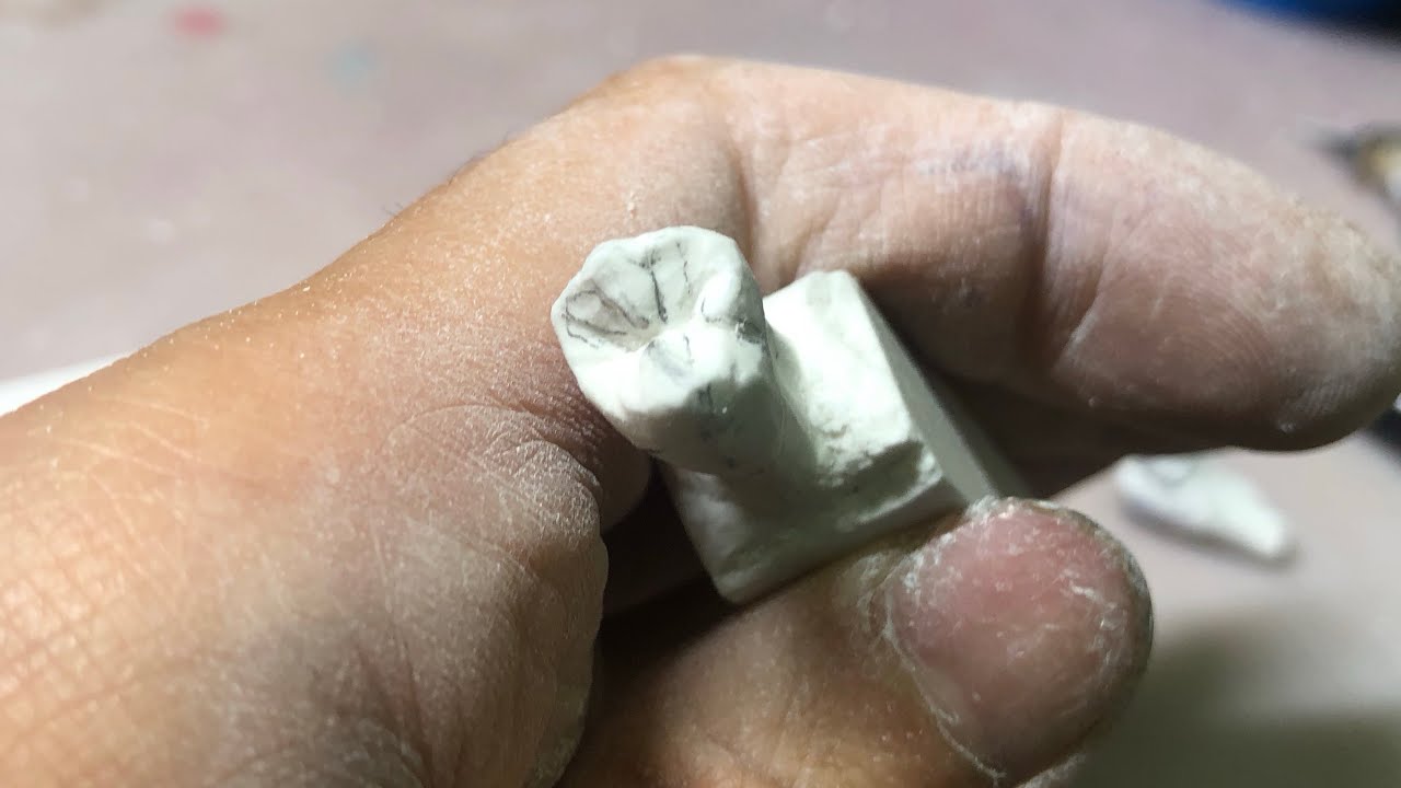 🔰もりもり方　歯型彫刻上顎4 学生さん向け