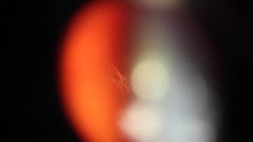 Floaters - Vitreolysis showing a weiss ring in a safe location - by Dr. Paul Singh