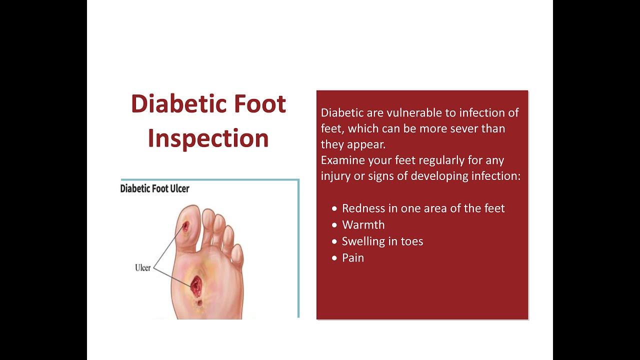 Diabetic Foot Inspection Tips YouTube