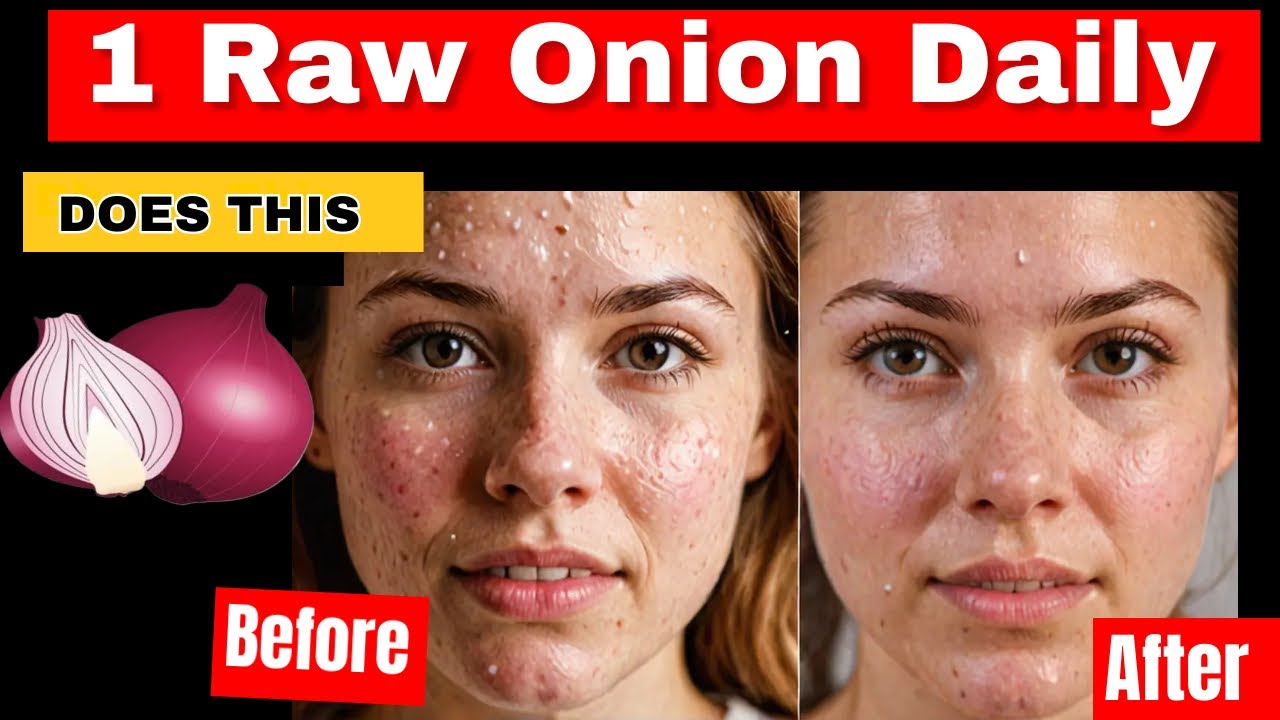 Как избавиться от прыщей за 3 дня: лечение прыщей луковым соком 