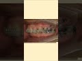 口ゴボ│男性の歯列矯正│Eライン│ワイヤー矯正│#shorts