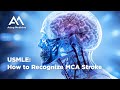 Usmle mca stroke how to recognize