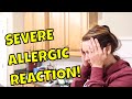 SEVERE ALLERGIC REACTION! Your Face Looks Awful!