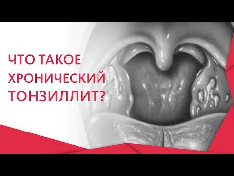 👏 Эффективные методы лечения хронического тонизиллита. Хронический тонзиллит лечение. 12+