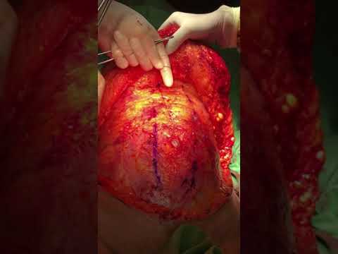 Tummy Tuck (Abdominoplasty) Surgery by Dr. Sheraz Raza Lahore