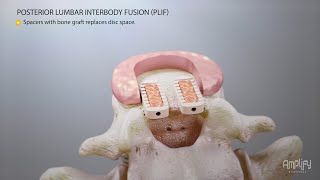 What is PLIF? | Posterior Lumbar Interbody Fusion