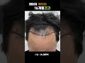 618번 비절개 3000 모발이식 정우석 사랑해