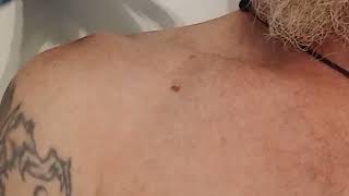 Cryotherapy sunspot removal in North London Before and After