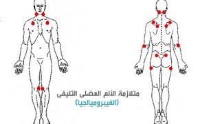 الفيبرومايلجيا،،، الالم العضلى الليفى ..الاعراض والاسباب والعلاج ...