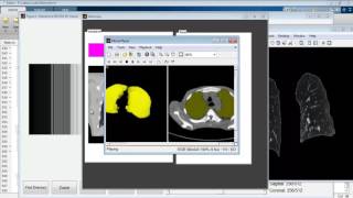 Celebrity Lung pulmonary nodule segmentation 3D Matlab projects Wealth