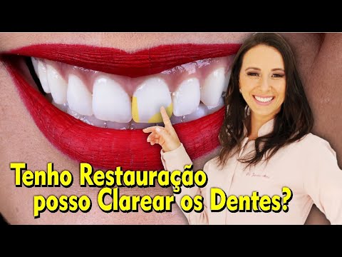 TENHO RESTAURAÇÃO, POSSO FAZER CLAREAMENTO DENTAL? Dra. Jaque Akemi - Londrina-PR