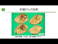 肝臓がん　最近の動向と治療法の選択