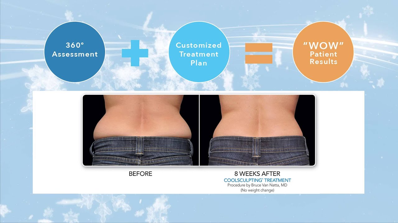 to Zeltiq CoolSculpting fat reduction and fear no mirror! YouTube