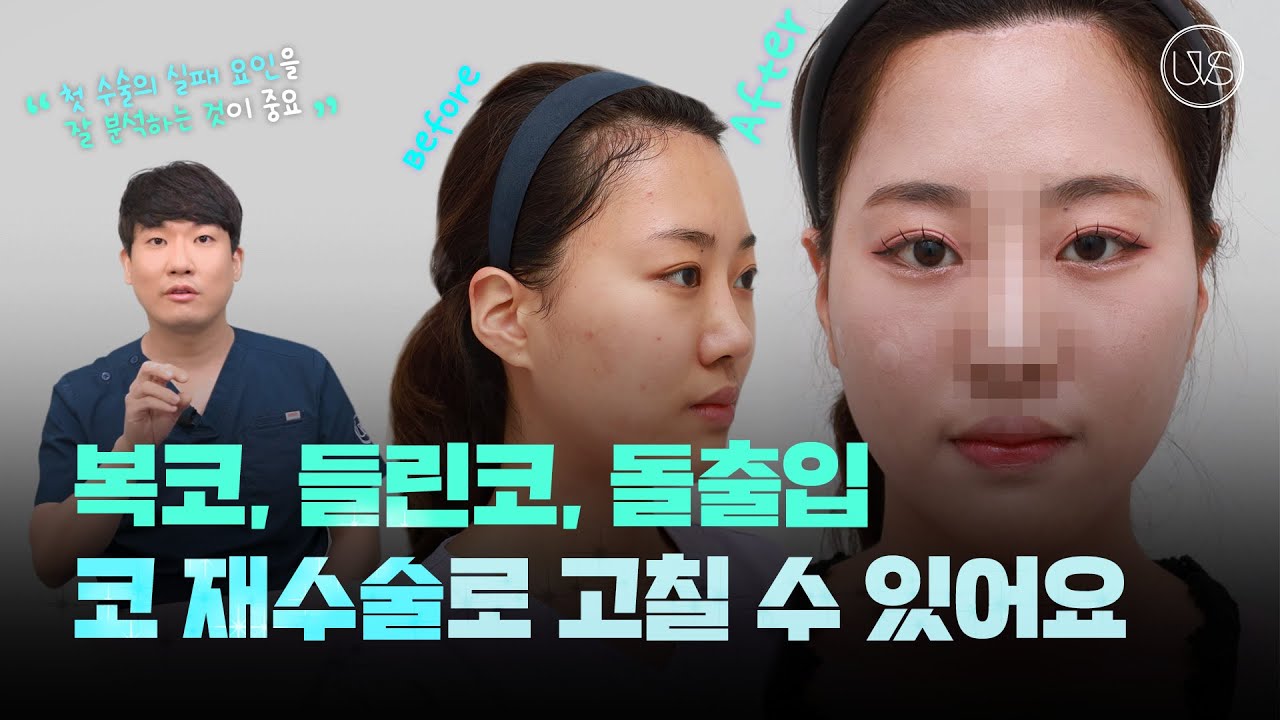 [Вивэрс Гоо Сайхны Мэс Заслын Эмнэлэг] Хамрын давтан мэс заслаар бөөрөнхий хамар, намхан хамар, дээшээ сөхсөн хамрын ул мөрийг бүрэн арилгалаа! Хамрын давтан мэс заслын сэтгэгдэл