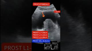 Ultrasound showing Enlarged prostate:prostatomegaly ultrasound