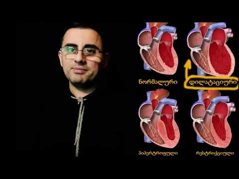 დილატაციური კარდიომიოპათია - მარტივად