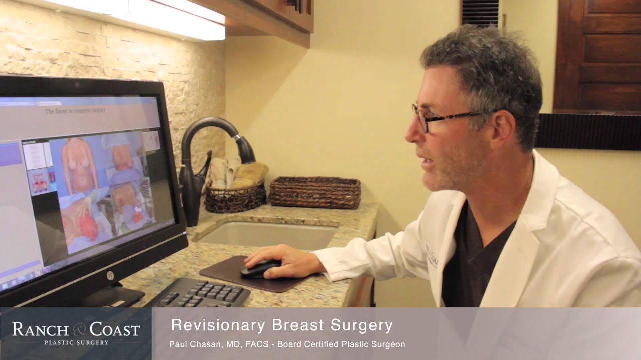 Best Revisionary Breast Reduction Surgery in San Diego Patient Testimonial and Review