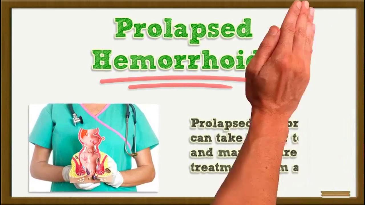 How Long Do Hemorrhoids Last Without & With Hemorrhoid Treatment YouTube