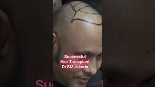 Successful Hair Transformation done by Dr Jakaria #haircare #hairsurgeon #hairtransplant
