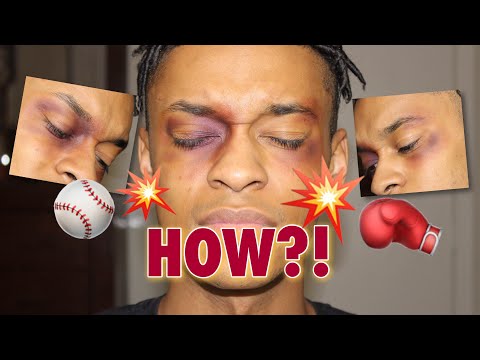 EASY Black Eye (Bruised Eye) Prank Tutorial | Makeup Monday