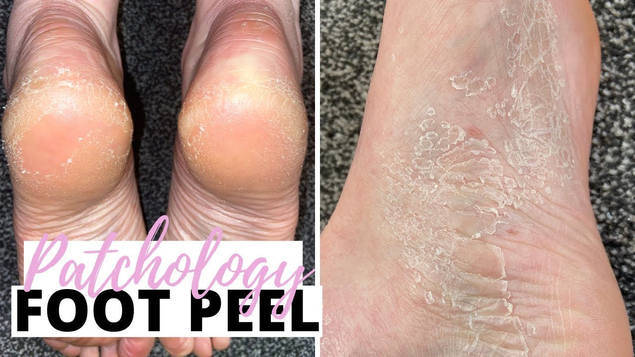I TRIED THE PATCHOLOGY FOOT PEEL SO YOU DON'T HAVE TO PATCHOLOGY POSH PEEL PEDICURE REVIEW🦶🏻😳🩰