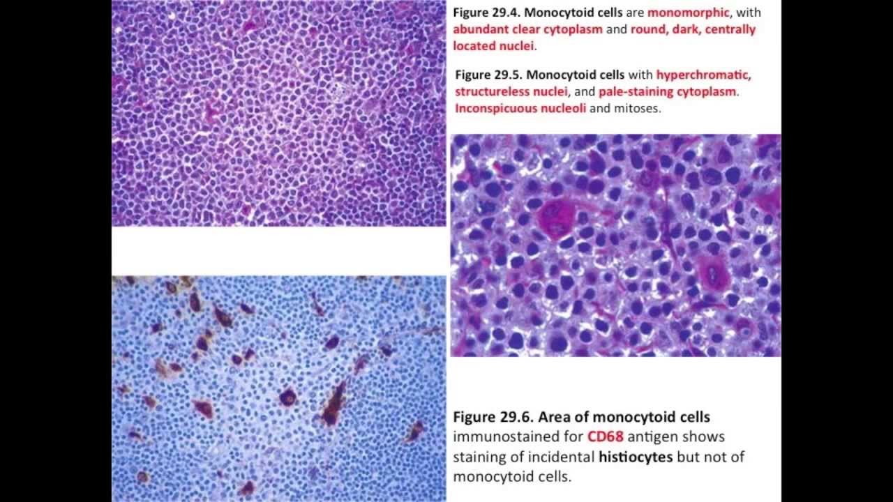 pathological lymph node