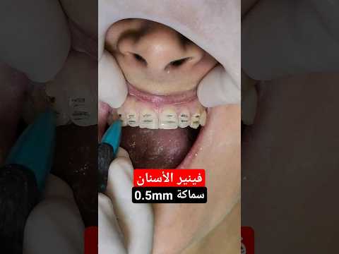 فينير الأسنان بدون برد