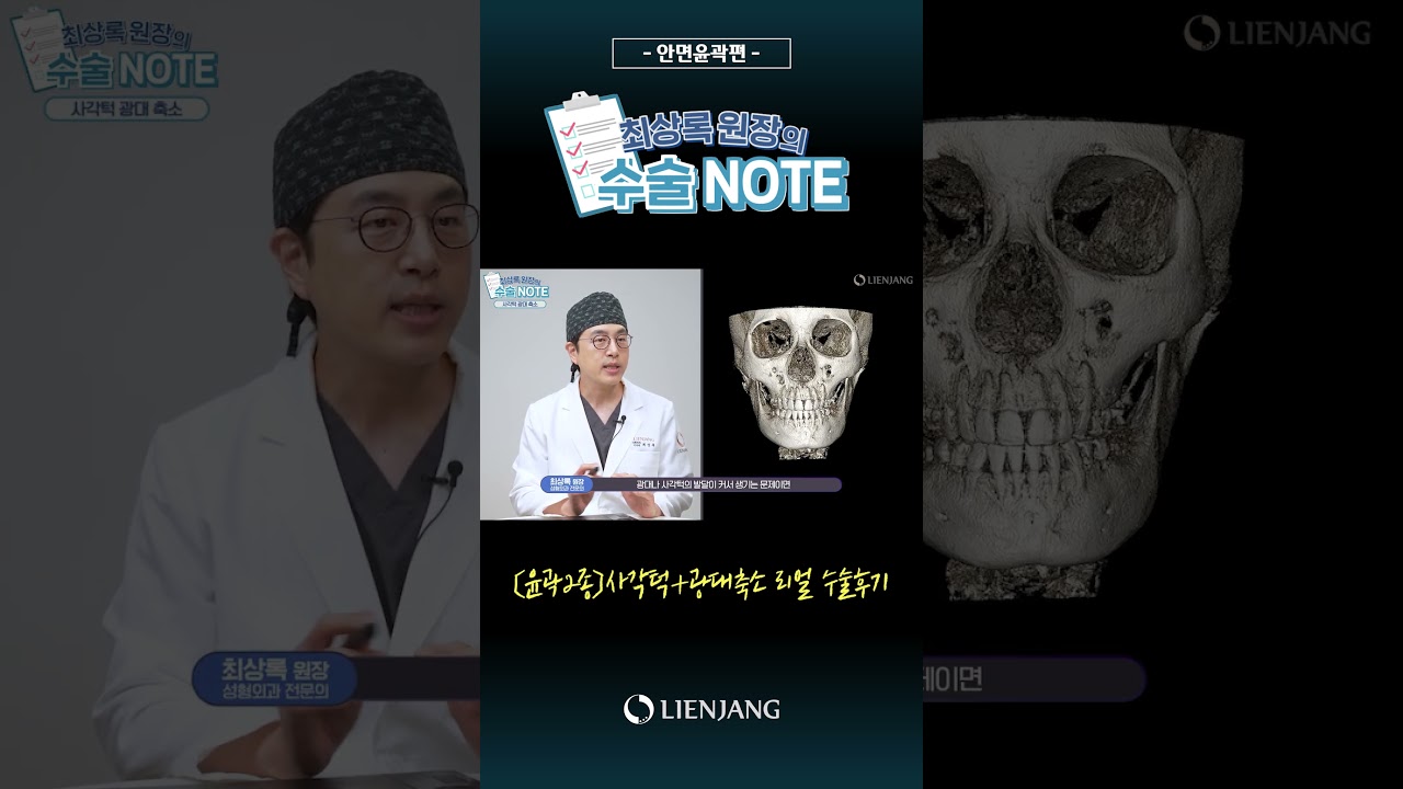 [Лиэнжанг гоо сайхны мэс заслын эмнэлэг] Дөрвөлжин эрүүтэй байсан ч одоо алга болсон🥰│Дөрвөлжин эрүүний хэлбэржүүлэлтийн мэс засал│КТ шинжилгээний кейс тойм