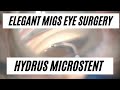 MIGS and Hydrus - Elegant Minimally Invasive Glaucoma Surgery // Your Eyes Tell