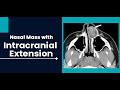 Nasal Mass with Intracranial Extension | Dr. Sukhdeep Singh Jhawar