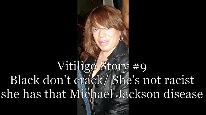 Vitiligo Story #9: Black don't crack/ She's not ra...