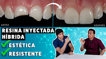 ¿Qué carillas son las más resistentes?