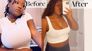 Breast Reduction Surgery  G to C cup (pictures included) 