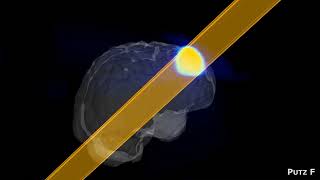 Stereotactic ARC treatment in radiosurgery (SRS) for brain metastases