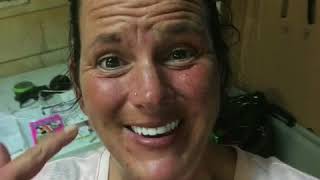 Horseshoe Snap-In Denture*Update
