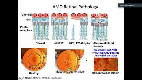 Targeting Mitochondria to Treat Age-related Macular Degeneration, Deborah A. Ferrington, PhD - UCI