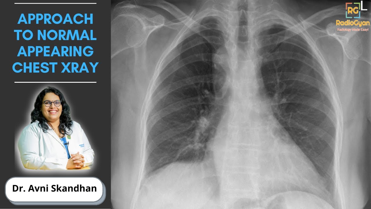 Approach To An Unremarkable Chest X Ray Dr Avni Skandhan YouTube