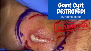 Ginormous Cyst Gets DELETED by Dr. Timothy Jochen