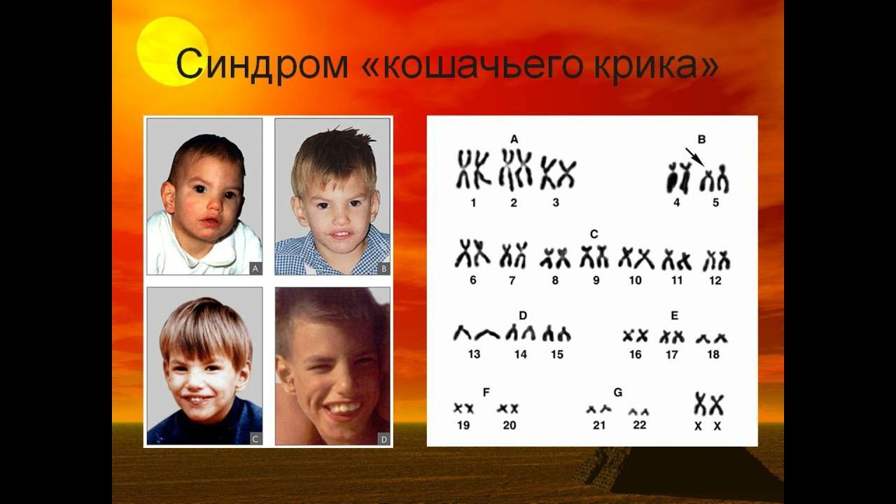 синдром кошачьего крика видео