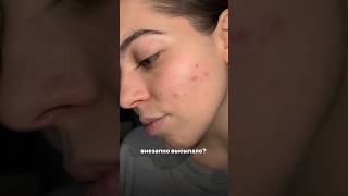 Не торопись паниковать лучше используй крем от прыщей арт 154859673 прыщи акне крем