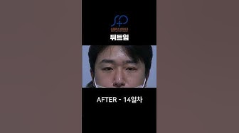 뒤트임전후 - Youtube