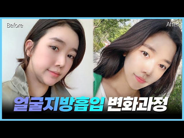얼굴지방흡입 수술 후 변화과정 궁금하셨다면?