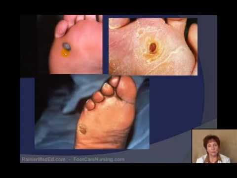 pictures of warts on feet #11