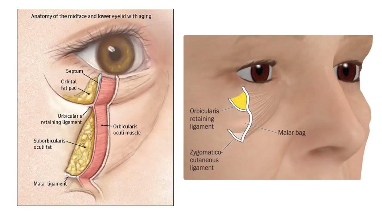 Kỹ Thuật Tiêm B.A.P Với Jalupro Super Hydro - Jalupro Việt Nam