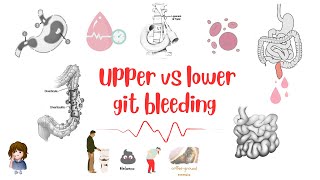 Upper Vs Lower Git Bleeding Definition Sites Patient Presentation