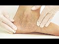 هل تعاني من عروق زرقاء؟ قوّي أوعية ساقيك بهذه الأطعمة Blue Veins? Strengthen Your Leg Vessels with These Foods هل تعاني من عروق زرقاء؟ قوّي أوعية ساقيك بهذه الأطعمة Blue Veins? Strengthen Your Leg Vessels with These Foods